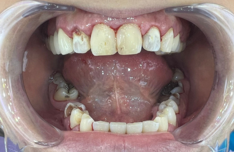 Coroane dentare refacute (1)