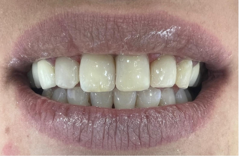 Coroane dentare refacute (2)